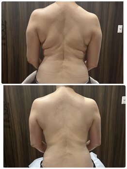 ミーラブ 鹿児島(miilove)の写真/40代からのウキウキ変化♪たった2回で背中がすっきり！！ボディーラインを整えながら身体の軽さも◎