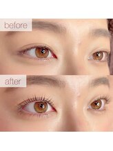 アミーラ(Amira)/パリジェンヌビフォーアフター