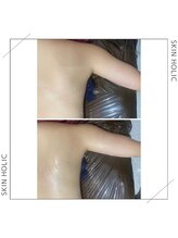 スキンホリック 恵比寿駅前店(SKIN HOLIC)/二の腕☆ビフォア＆アフター★
