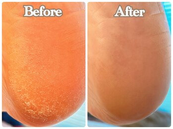 サロン カラフリー アシヤ(Salon Colorfulyy Ashiya)/ガサガサ踵改善コース施術例