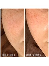 ルネ(Lune)/超音波(ソニックエステ)