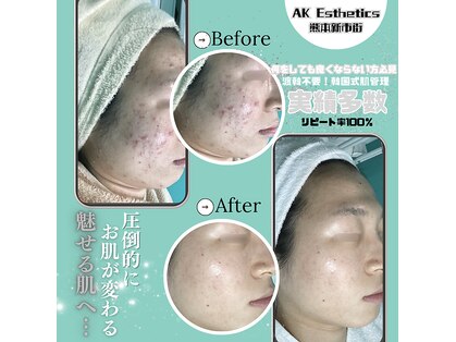 エーケーエステティックス 熊本新市街店(AK Esthetics)の写真