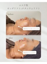 アモ 夢シティ新下関(AMO.)/チタニウムリフト