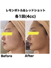 マスカレード(Masquerade)/レモンボトル＆レッドショット