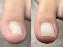 ヌル ネイル 堀江(NURU NAIL HORIE)/巻き爪矯正beforeafter★