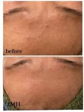 エリーズ(Elise)/肌質改善（ハーブピーリング）