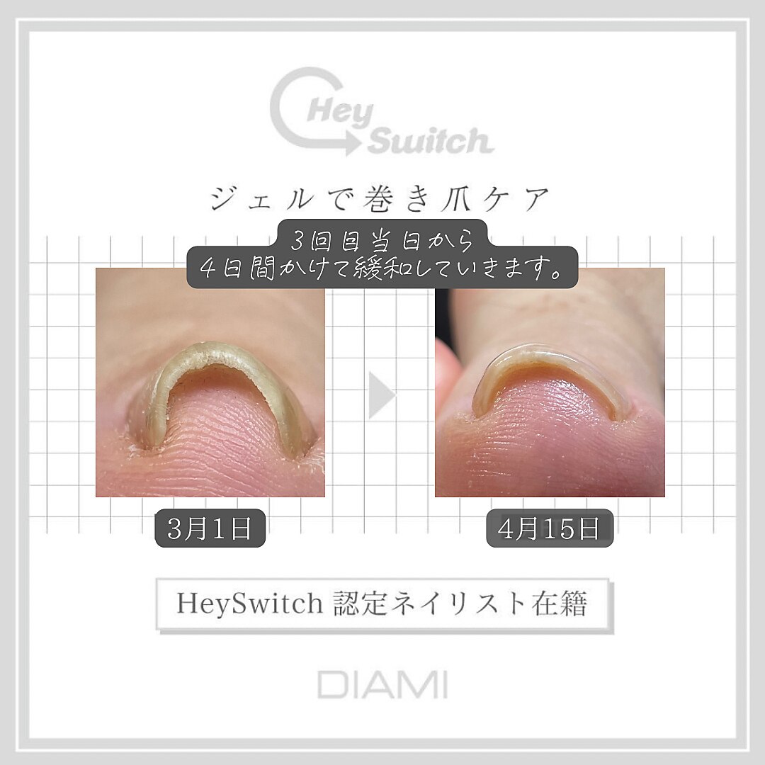 新品未開封品 巻き爪ケア HEY SWITCH 3種セット Hey Switchディプロマ取得 （巻き爪🦶） | 東京｜渋谷のネイルスクール
