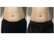 OBS/老廃物流しでリンパの詰まりオフ