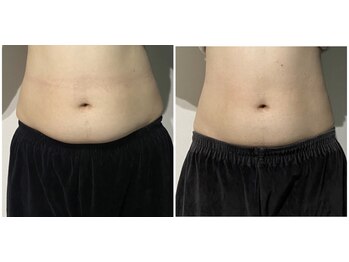 OBS/老廃物流しでリンパの詰まりオフ