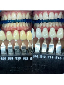トウキョウスワーズ 池袋店(TOKYO SWRS)/#ホワイトニング #池袋 #渋谷