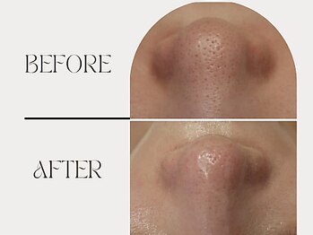 ニコリ(NICOLI)/深さがある毛穴もお任せください