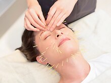 ビハリスト 新宿南口の雰囲気（効果の即効性&効果が長続きする美容鍼が当院の特徴【美容鍼】）