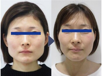 美デザイン 京橋店(美.design)/☆小顔矯正+頭蓋骨矯正+首肩矯正