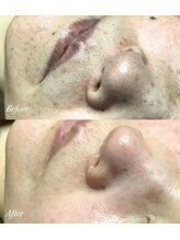 エミルカ 仙台(EMILUCA)/陶肌トリートメント