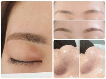 トータルビューティ ノイド(Noid)/小鼻コース+美眉毛WAX脱毛