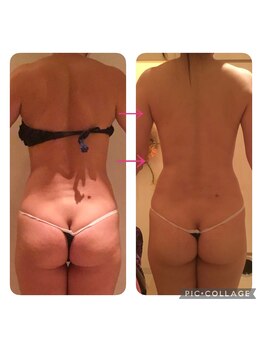 ビューティースパ/【1回で】エンダモロジー+反射区