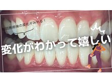 白く輝く歯は、表情だけでなく気持ちも変わります(^^)