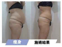 セルフィッシュビューティー/痩身／施術結果