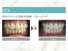 アンマープラス(Anmmer+)/白にこだわる (ホワイトニング)