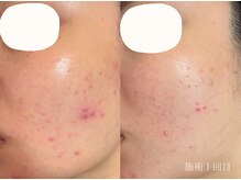 コム(comme39)/ニキビ・赤みでお悩みの方に