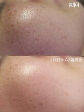 ベビースキン(baby skin)/肌改善