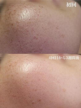 ベビースキン(baby skin)/肌改善