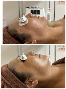 ブリリアント(Brilliant)/シミ ハリ ニキビ 毛穴