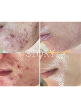 ストーリー 沼津店(STORY)&nbsp;ハーブ ピーリング