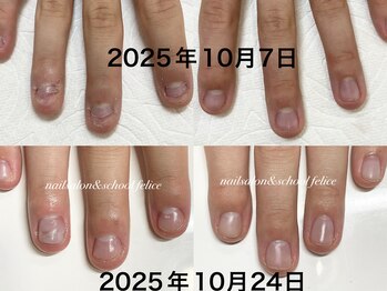 男性深爪矯正17日目