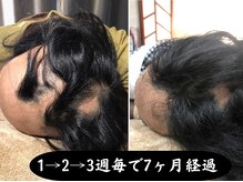 セントラル鍼灸院リラクシー(Re:laxy)/皮膚のただれ抜毛で、すがる思い