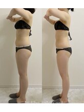 アピ(api)/症例写真【インディバ】