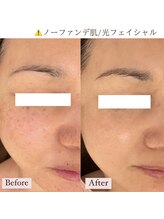 ミラ(Mila)/光フェイシャル1年BeforeAfter☆