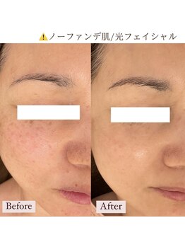 ミラ(Mila)/光フェイシャル1年BeforeAfter☆