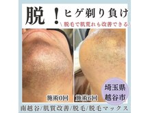 脱毛マックス 南越谷店(MAX)
