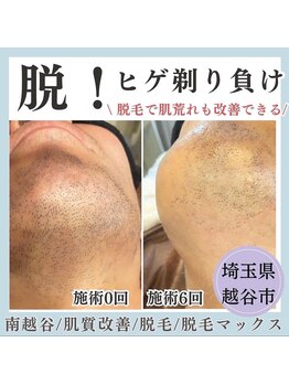 脱毛マックス 南越谷店(MAX)の写真/【結果重視】気になるムダ毛を徹底ケア!!ヒゲ脱毛/VIO脱毛が大人気☆都度払いもコース通いもOK♪