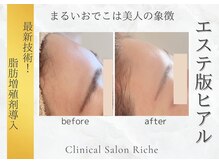 リッシュ 神戸岡本院(RICHE)の雰囲気（常識を覆す次世代ヒアル★ヒアルリッチで理想のパーツが叶う）