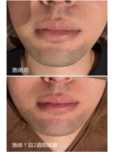 オアシスサカエ(OASIS SAKAE)/【髭脱毛】Before、after