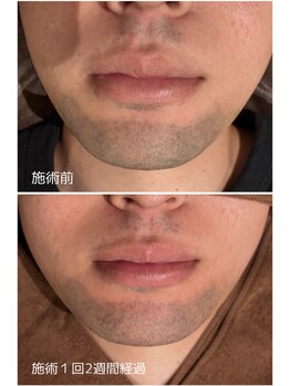 オアシスサカエ(OASIS SAKAE)/【髭脱毛】Before、after