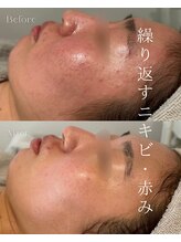 エメ(Aimee) ニキビ毛穴 肌質改善