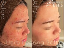 ベル 柏(Belle)の雰囲気（【お得なサブスクも*】ダーマ/ハーブピーリングでニキビ毛穴ケア）