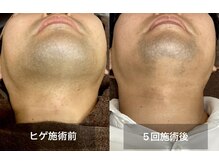 リリー(RILY)の雰囲気（1番人気のヒゲ脱毛♪髭剃り不要に最短で導きます!メンズ脱毛/VIO）