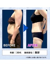 ディア(DiA)/【脂肪冷却】before after