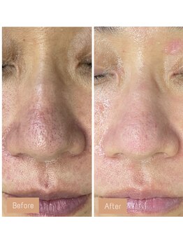 FJ/毛穴黒ずみ開きに◎フェイシャル