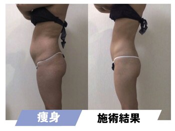 セルフィッシュビューティー/痩身／施術結果