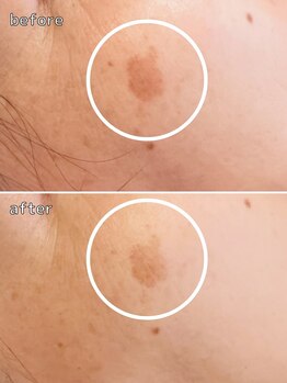 メイクアップス(makeups)/シミケア　4回