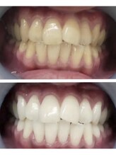 ラブホワイトニング 池袋店(LOVEホワイトニング)/ホワイトニング/ホワイトニング