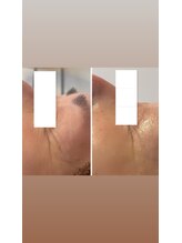 バニスター(Bannister)/ハーブピーリング