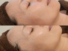 フリージア(Freesia)/【2】　ヒト幹細胞フェイシャル