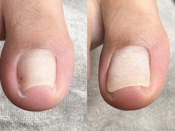 ヌル ネイル 堀江(NURU NAIL HORIE)/巻き爪矯正beforeafter☆