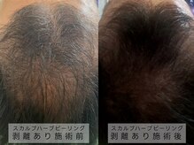 育肌美研 自由が丘サロン/頭皮ケア｜ハーブピーリング